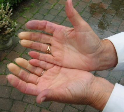 24 ottobre: seminario informativo <br>sulla diagnosi precoce della Sclerosi Sistemica (fenomeno di Raynaud)